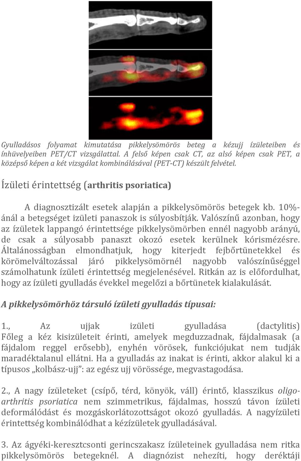 Ízületi érintettség (arthritis psoriatica) A diagnosztizált esetek alapján a pikkelysömörös betegek kb. 10%- ánál a betegséget izületi panaszok is súlyosbítják.