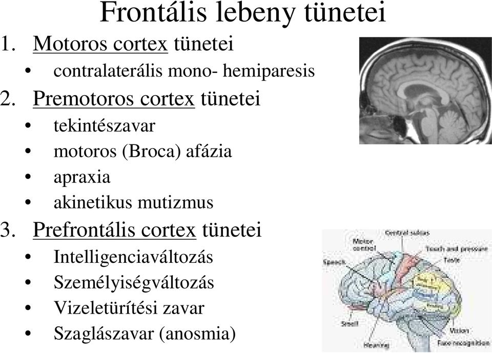 Premotoros cortex tünetei tekintészavar motoros (Broca) afázia apraxia