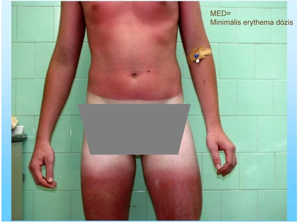 erythema