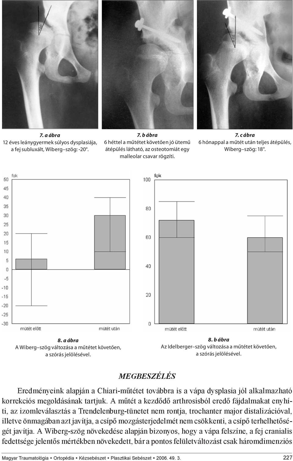 MEGBESZÉLÉS Eredményeink alapján a Chiari-műtétet továbbra is a vápa dysplasia jól alkalmazható korrekciós megoldásának tartjuk.