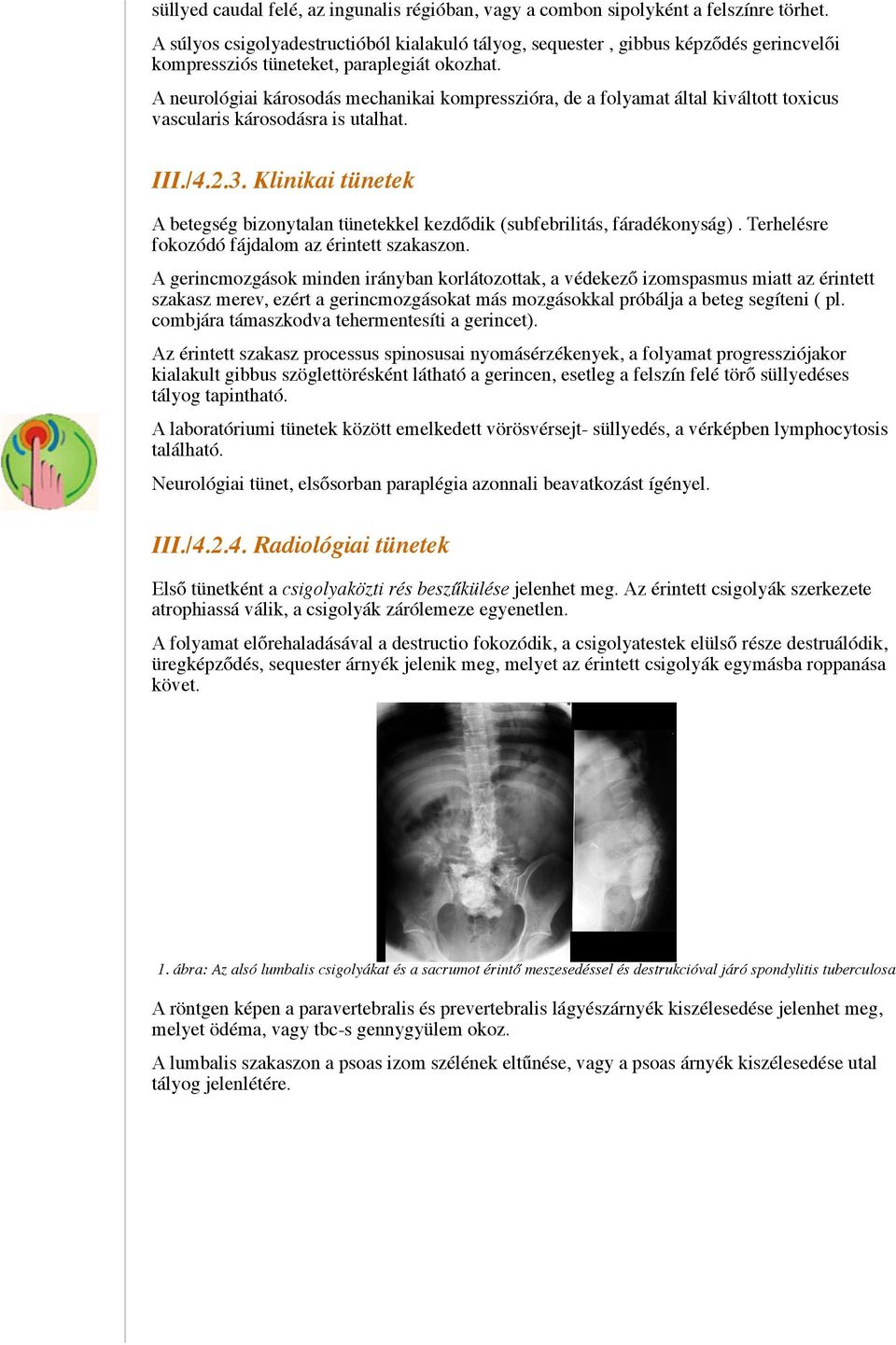 A neurológiai károsodás mechanikai kompresszióra, de a folyamat által kiváltott toxicus vascularis károsodásra is utalhat. III./4.2.3.