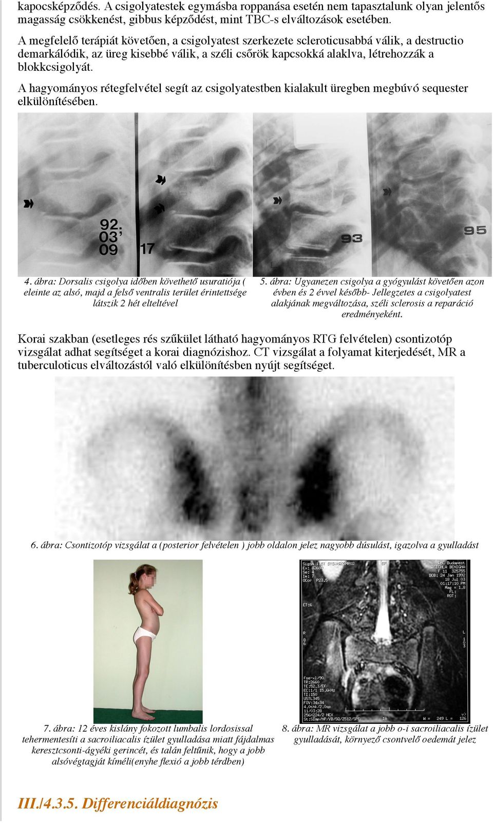 A hagyományos rétegfelvétel segít az csigolyatestben kialakult üregben megbúvó sequester elkülönítésében. 4.