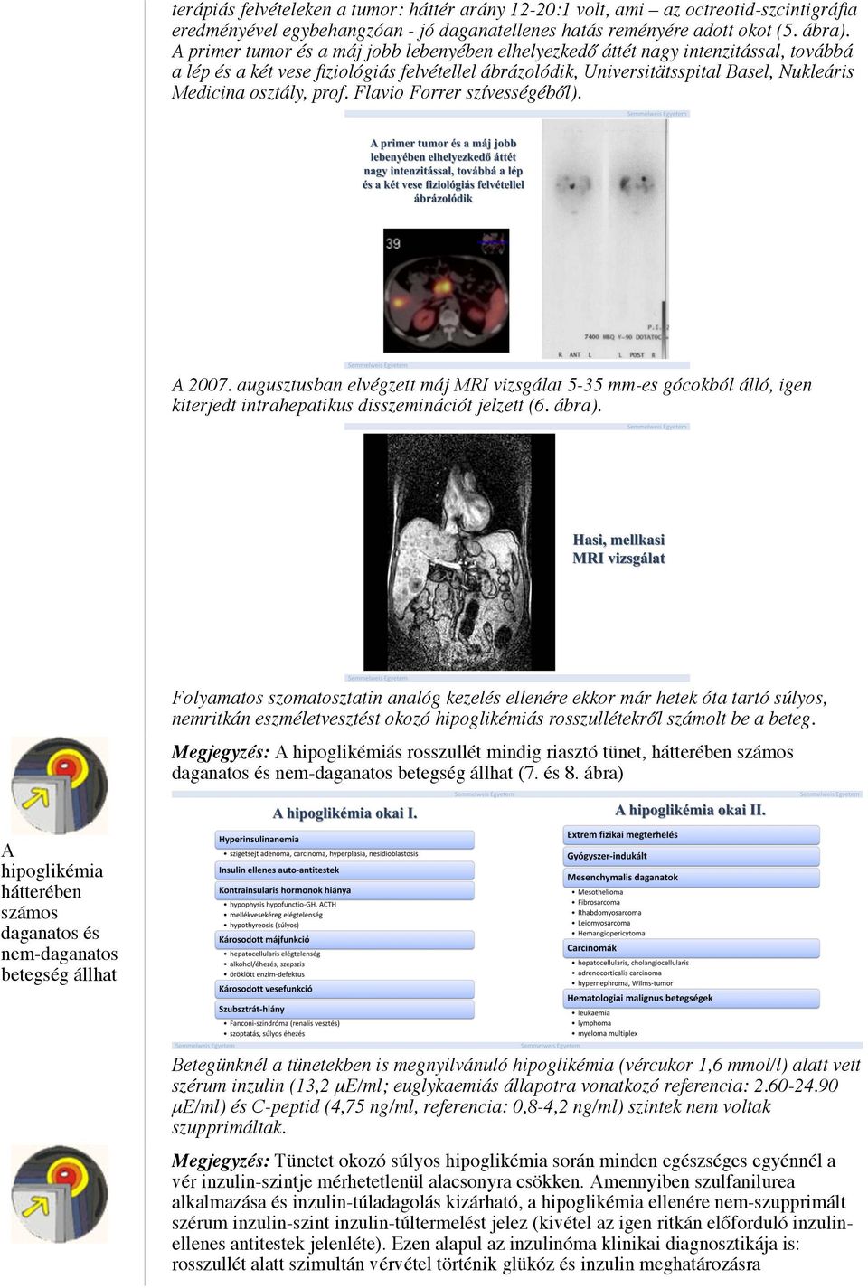 prof. Flavio Forrer szívességéből). A 2007. augusztusban elvégzett máj MRI vizsgálat 5-35 mm-es gócokból álló, igen kiterjedt intrahepatikus disszeminációt jelzett (6. ábra).