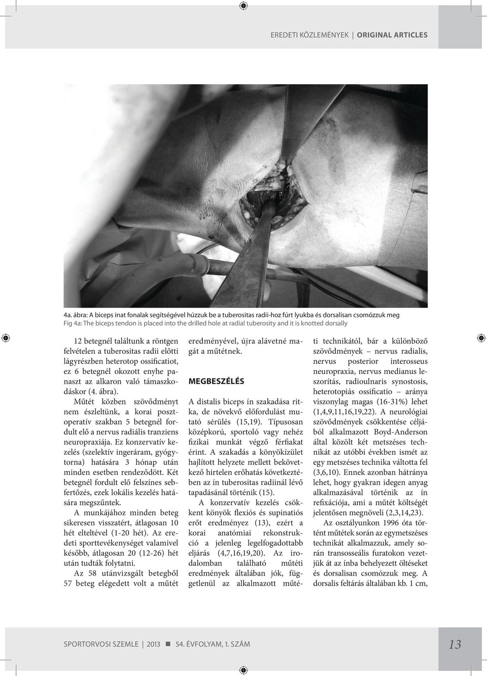 it is knotted dorsally 12 betegnél találtunk a röntgen felvételen a tuberositas radii előtti lágyrészben heterotop ossificatiot, ez 6 betegnél okozott enyhe panaszt az alkaron való támaszkodáskor (4.