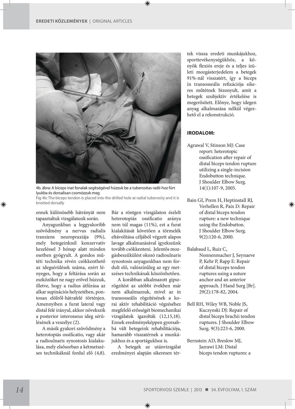 ábra: A biceps inat fonalak segítségével húzzuk be a tuberositas radii-hoz fúrt lyukba és dorsalisan csomózzuk meg Fig 4b: The biceps tendon is placed into the drilled hole at radial tuberosity and