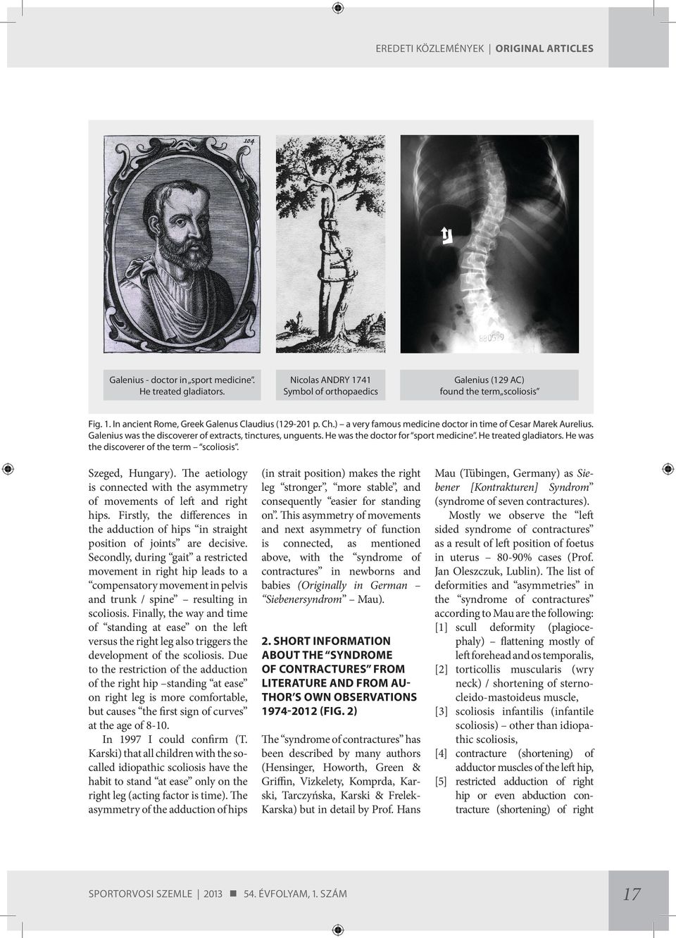 He was the discoverer of the term scoliosis. Szeged, Hungary). The aetiology is connected with the asymmetry of movements of left and right hips.