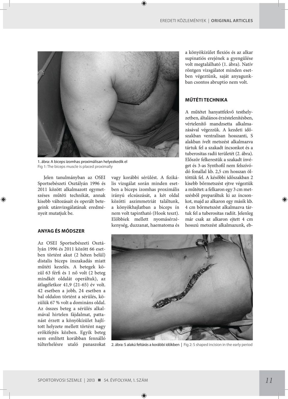 ábra: A biceps izomhas proximálisan helyezkedik el Fig 1: The biceps muscle is placed proximally Jelen tanulmányban az OSEI Sportsebészeti Osztályán 1996 és 2011 között alkalmazott egymetszéses