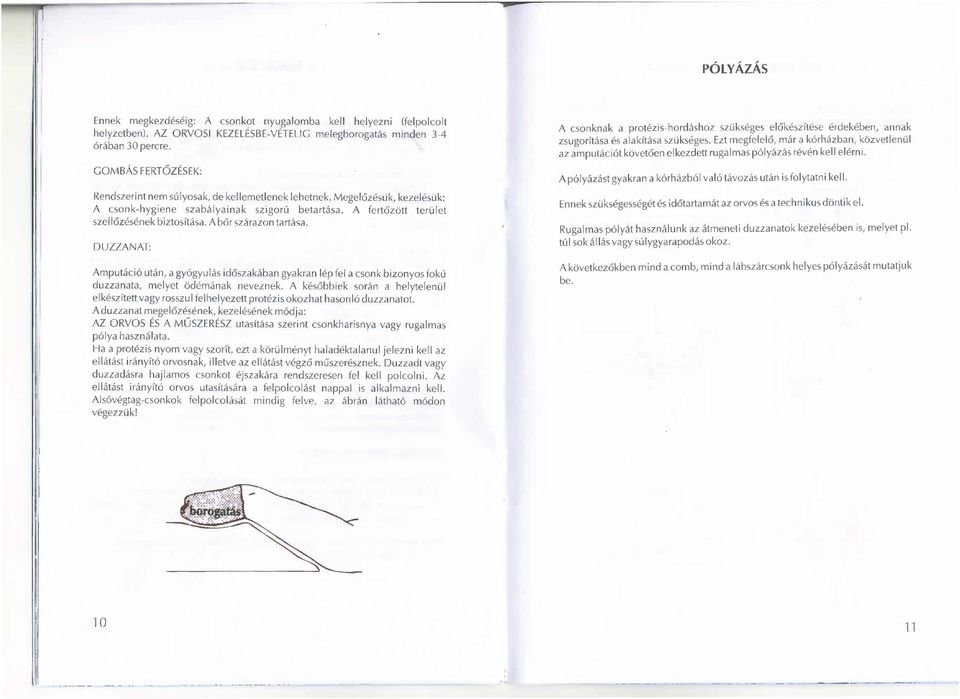 A bőr szárazon tartása. DUZZANAT: Amputáció után, a gyógyulás időszakában gyakran lép fel a csonk bizonyos fokú duzzanata, melyet ödémának neveznek.