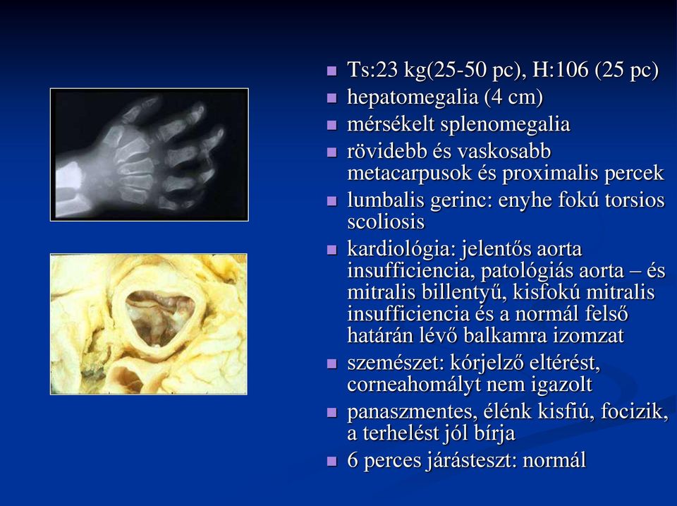 aorta és mitralis billentyű, kisfokú mitralis insufficiencia és a normál felső határán lévő balkamra izomzat szemészet: