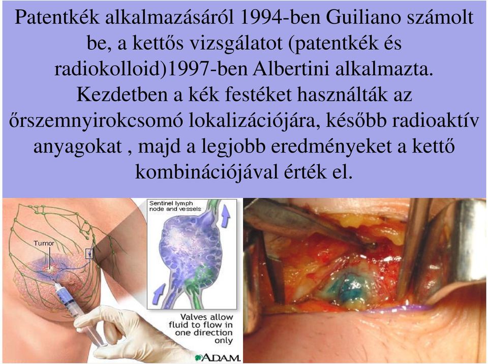 Kezdetben a kék festéket használták az őrszemnyirokcsomó lokalizációjára,