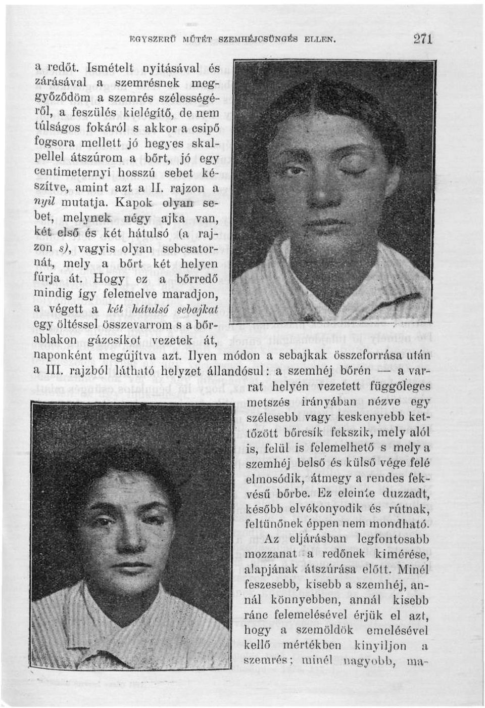 jó egy centiméternyi hosszú sebet készítve, amint azt a II. rajzon a nyü mutatja.