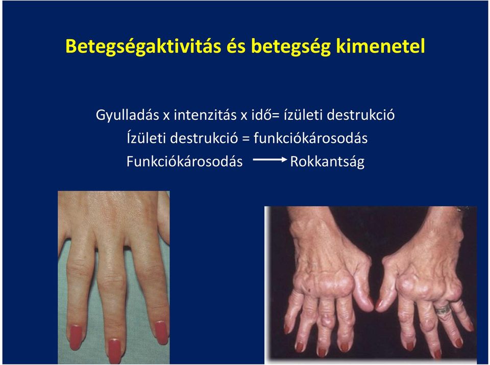ízületi betegségek prevalenciájának osztályozása az artrózis nem kezelésének következményei