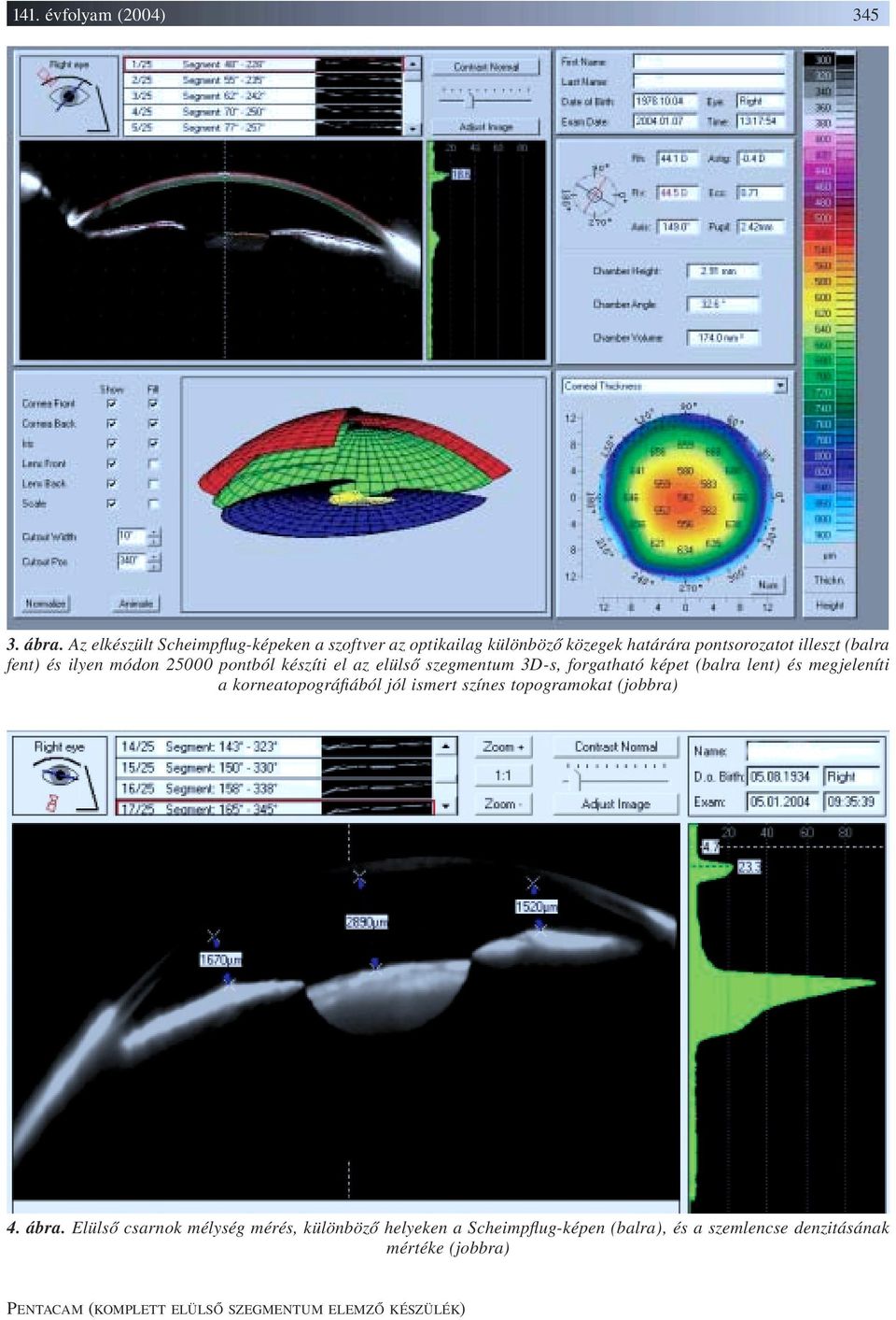 módon 25000 pontból készíti el az elülső szegmentum 3D-s, forgatható képet (balra lent) és megjeleníti a korneatopográfiából jól