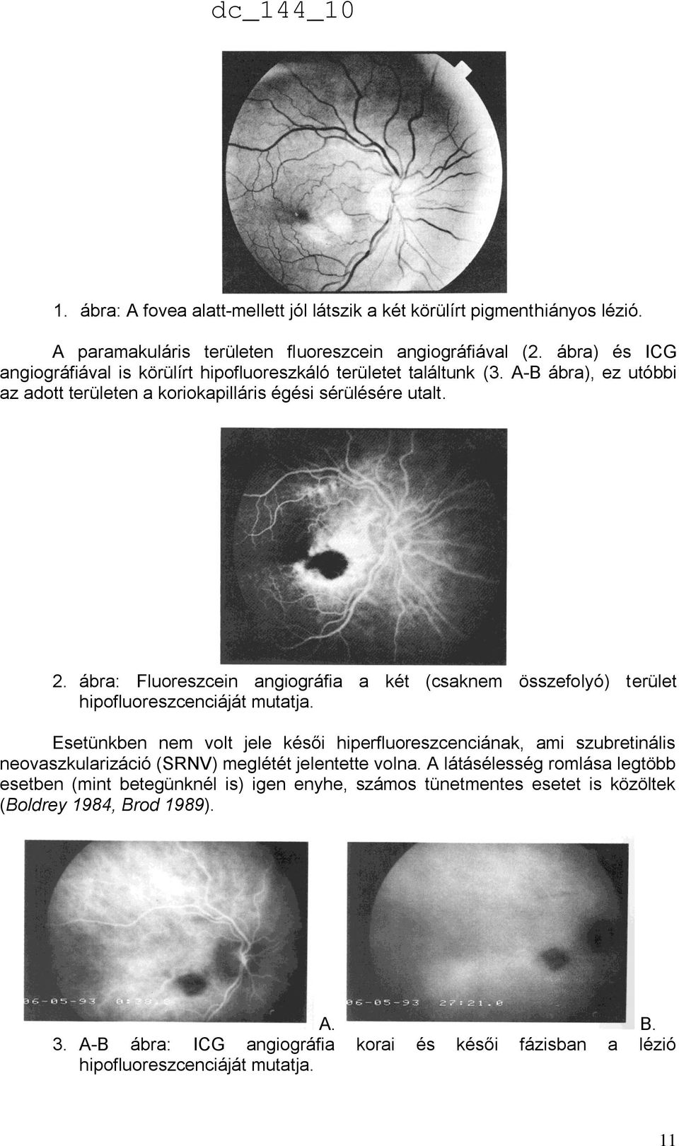 ábra: Fluoreszcein angiográfia a két (csaknem összefolyó) terület hipofluoreszcenciáját mutatja.