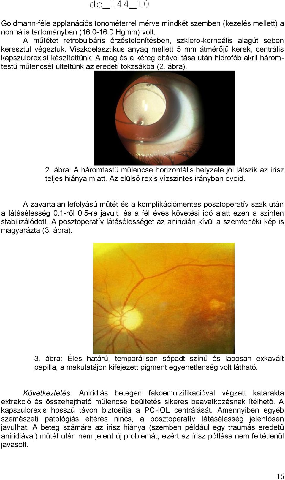 A mag és a kéreg eltávolítása után hidrofób akril háromtestű műlencsét ültettünk az eredeti tokzsákba (2. ábra). 2.