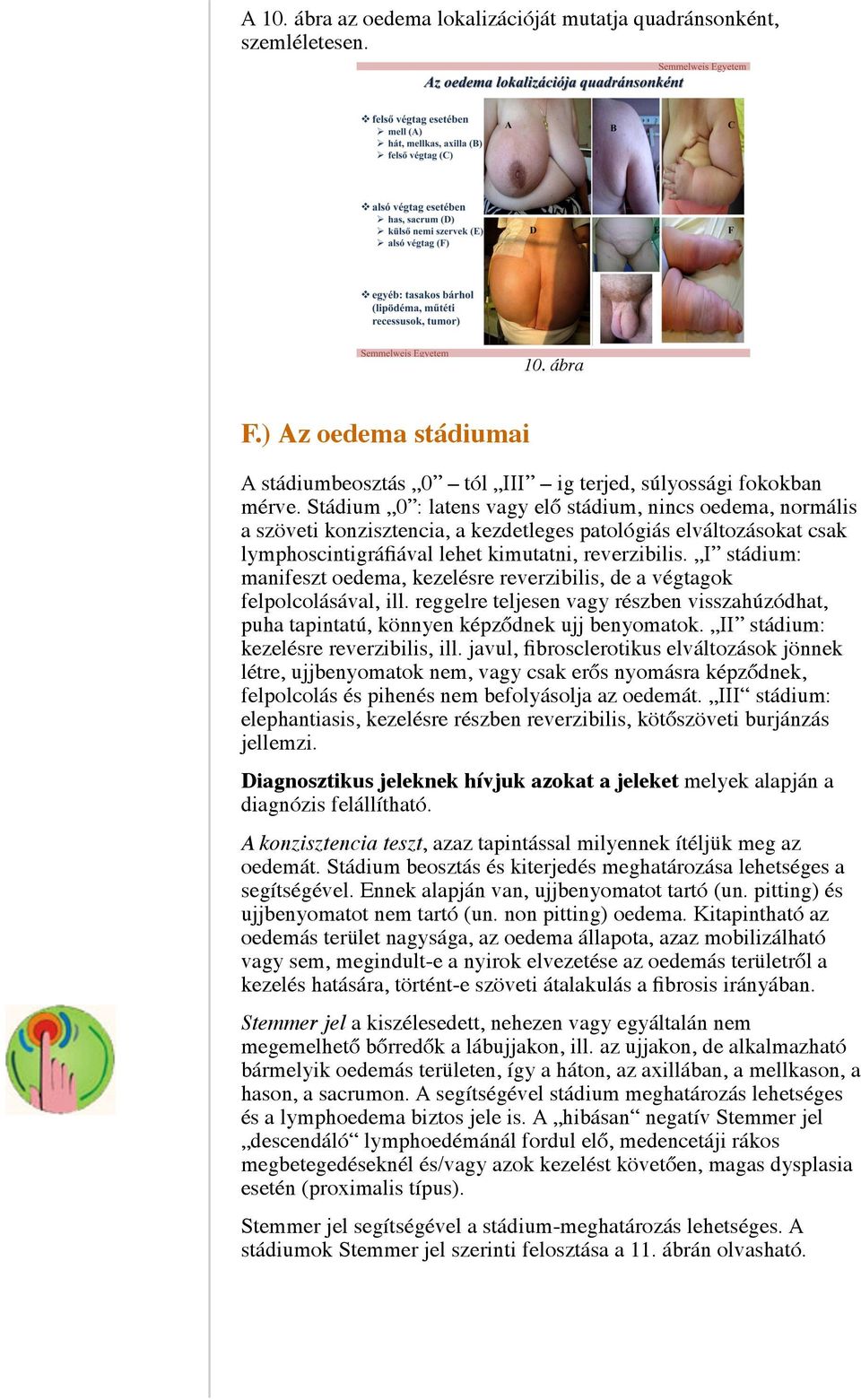 I stádium: manifeszt oedema, kezelésre reverzibilis, de a végtagok felpolcolásával, ill. reggelre teljesen vagy részben visszahúzódhat, puha tapintatú, könnyen képződnek ujj benyomatok.