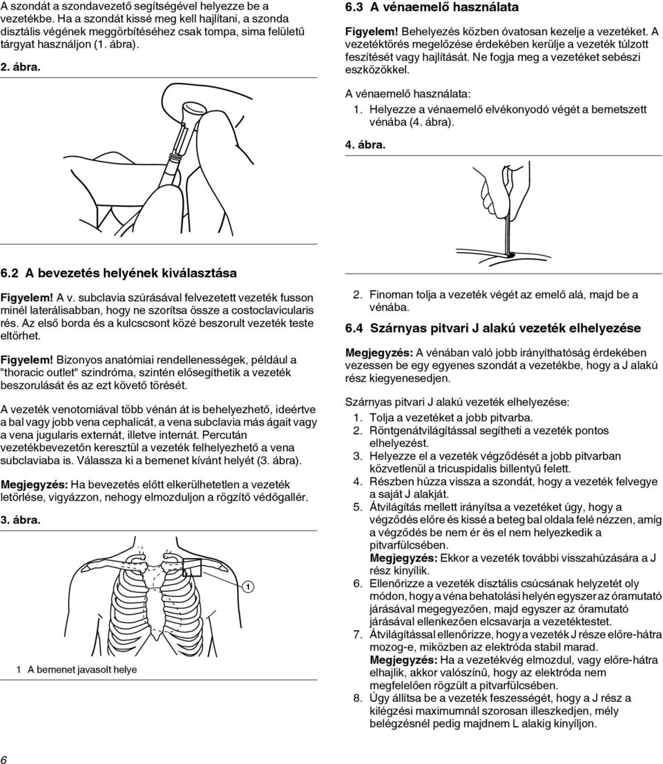 Ne fogja meg a vezetéket sebészi eszközökkel. A vénaemelő használata: 1. Helyezze a vénaemelő elvékonyodó végét a bemetszett vénába (4. ábra). 4. ábra. 6.2 A bevezetés helyének kiválasztása Figyelem!