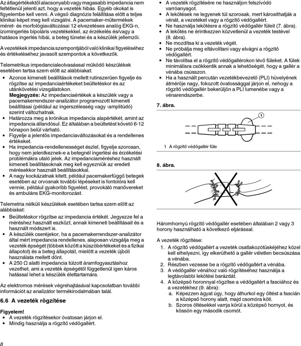 A pacemaker-műtermékek méret- és morfológiaváltozásai 12 elvezetéses analóg EKG-n, izomingerlés bipoláris vezetékekkel, az érzékelés és/vagy a hatásos ingerlés hibái, a beteg tünetei és a készülék