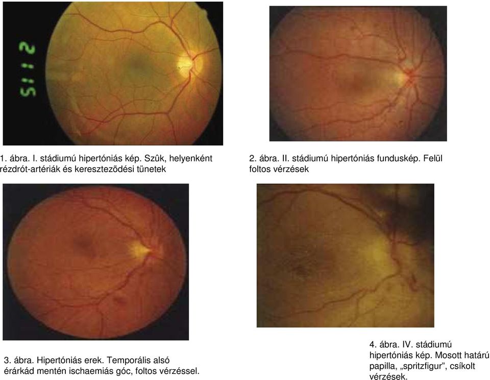 stádiumú hipertóniás funduskép. Felül foltos vérzések 3. ábra. Hipertóniás erek.