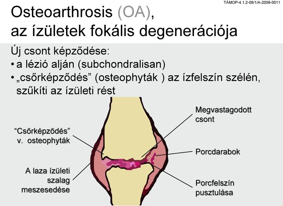 csőrképződés (osteophyták ) az ízfelszín szélén, szűkíti az ízületi rést