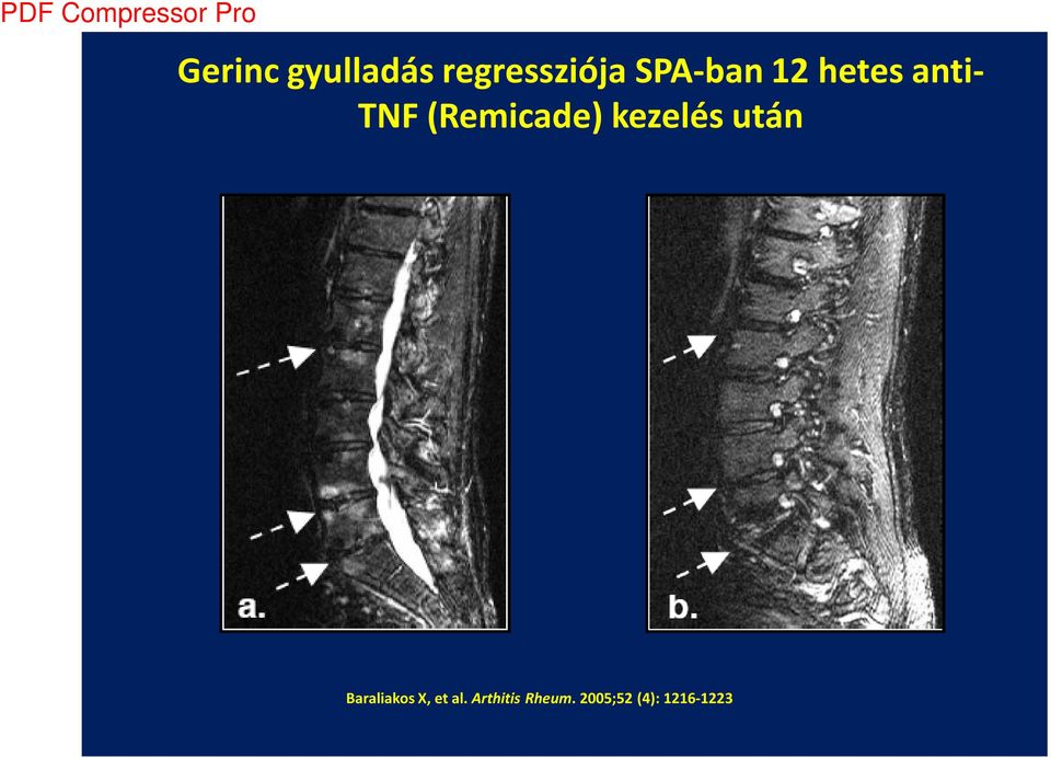 (Remicade) kezelés után Baraliakos