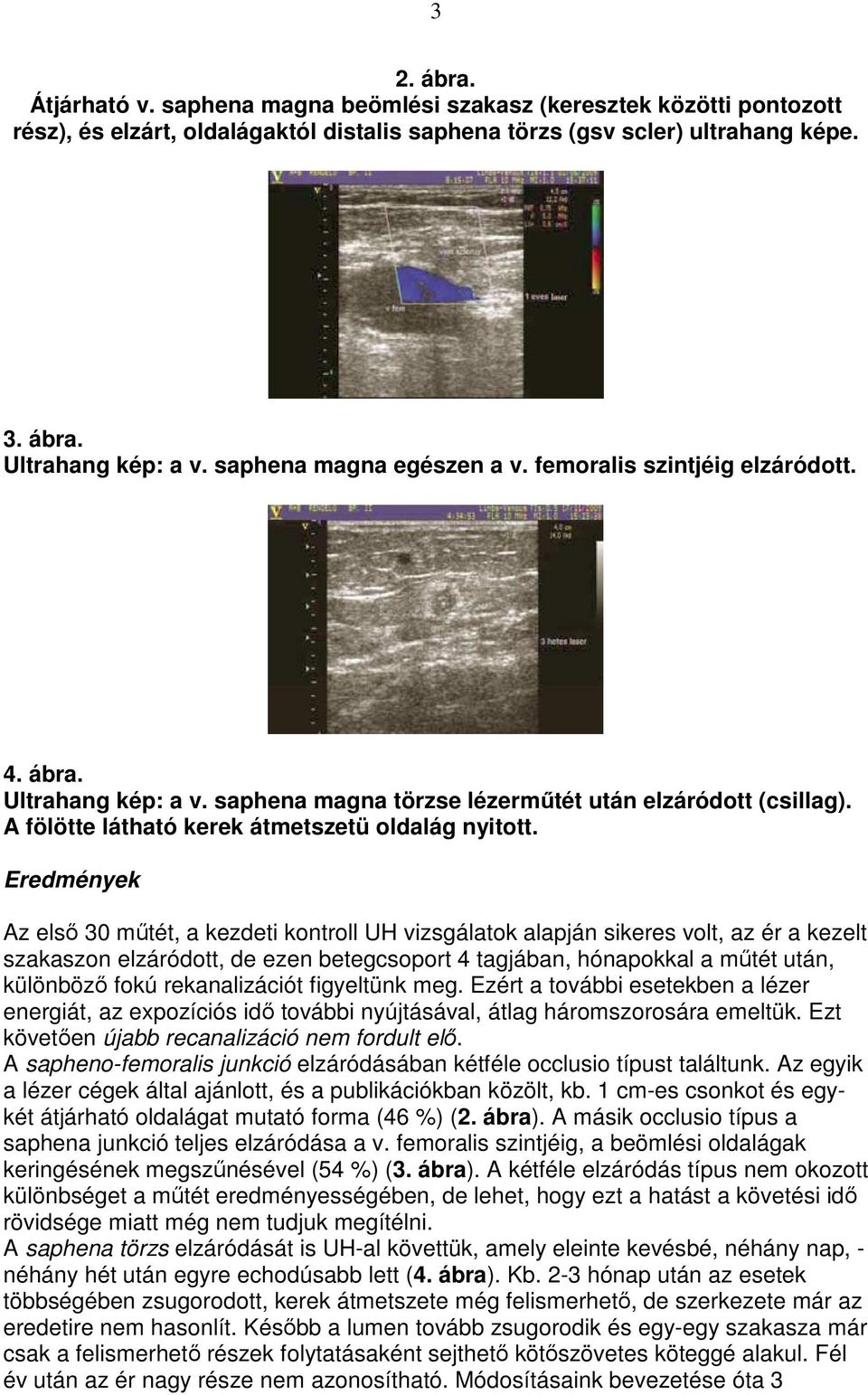 Eredmények Az elsı 30 mőtét, a kezdeti kontroll UH vizsgálatok alapján sikeres volt, az ér a kezelt szakaszon elzáródott, de ezen betegcsoport 4 tagjában, hónapokkal a mőtét után, különbözı fokú