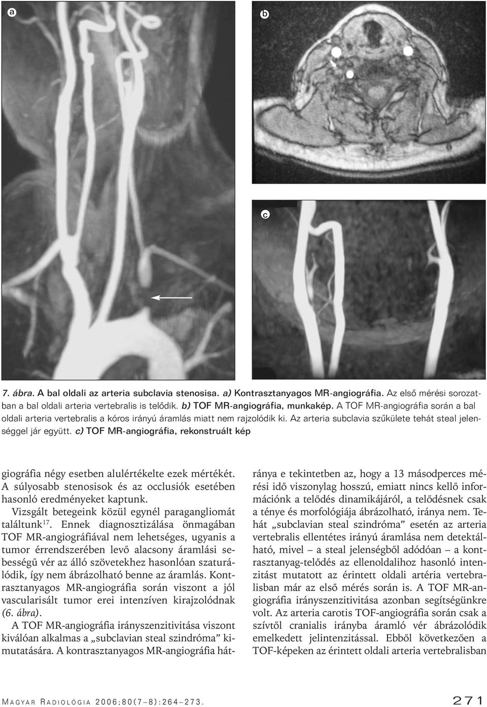 c) TOF MR-angiográfia, rekonstruált kép giográfia négy esetben alulértékelte ezek mértékét. A súlyosabb stenosisok és az occlusiók esetében hasonló eredményeket kaptunk.