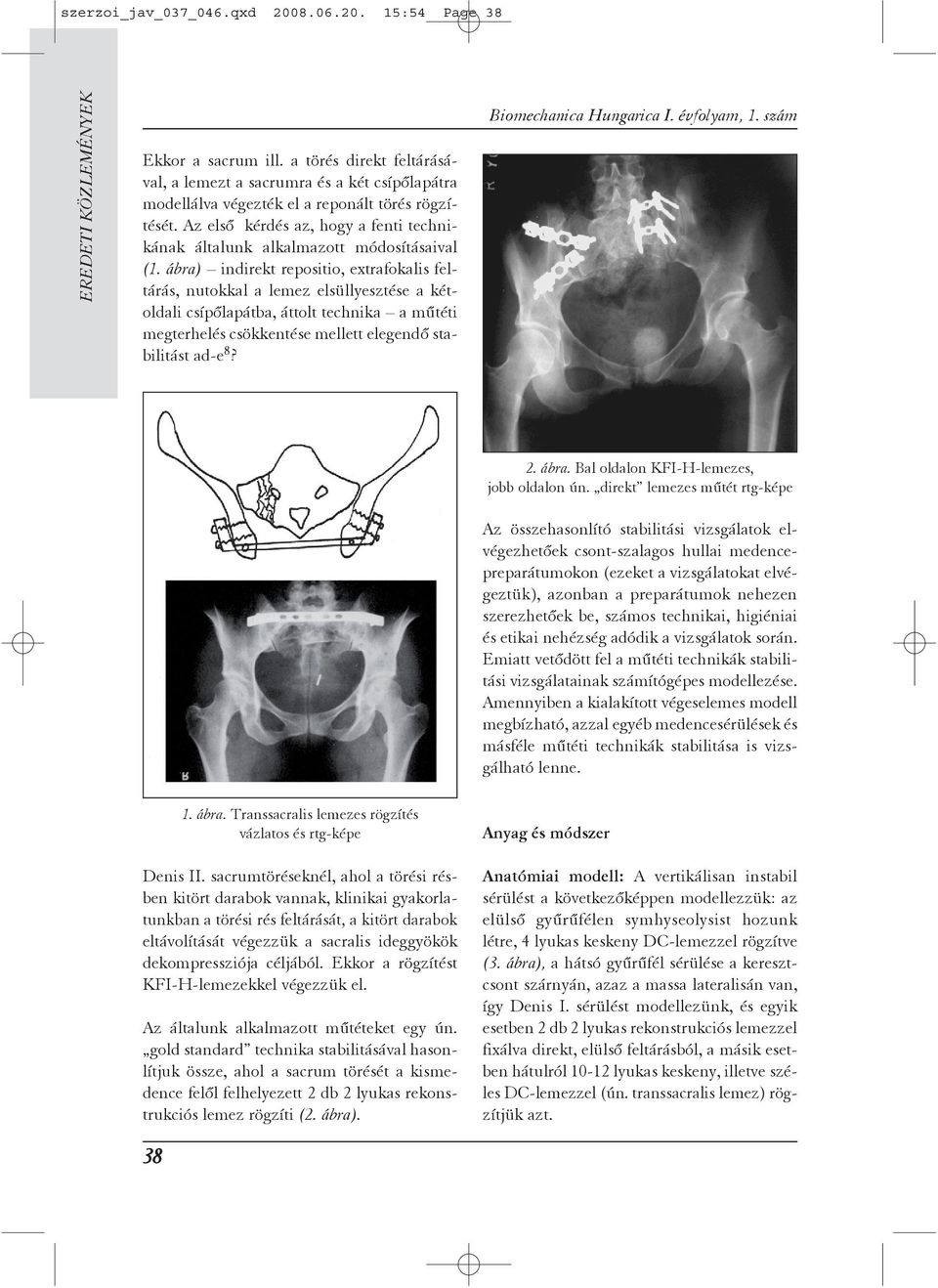 ábra) indirekt repositio, extrafokalis feltárás, nutokkal a lemez elsüllyesztése a kétoldali csípõlapátba, áttolt technika a mûtéti megterhelés csökkentése mellett elegendõ stabilitást ad-e 8? 2.