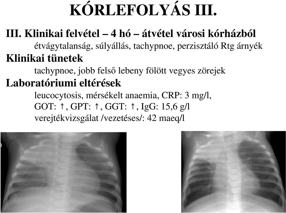 tachypnoe, perzisztáló Rtg árnyék Klinikai tünetek tachypnoe, jobb felsı lebeny