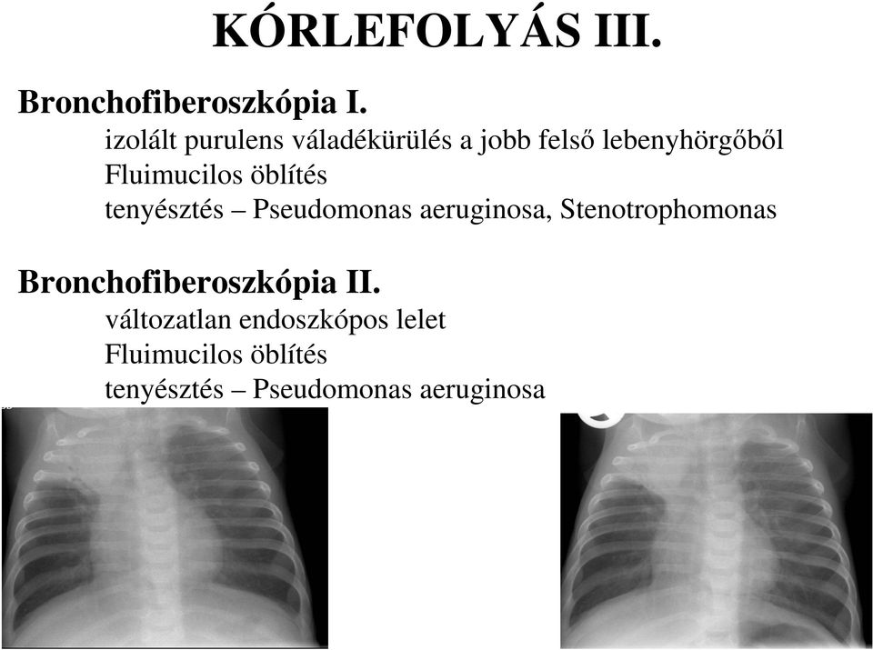 Fluimucilos öblítés tenyésztés Pseudomonas aeruginosa,