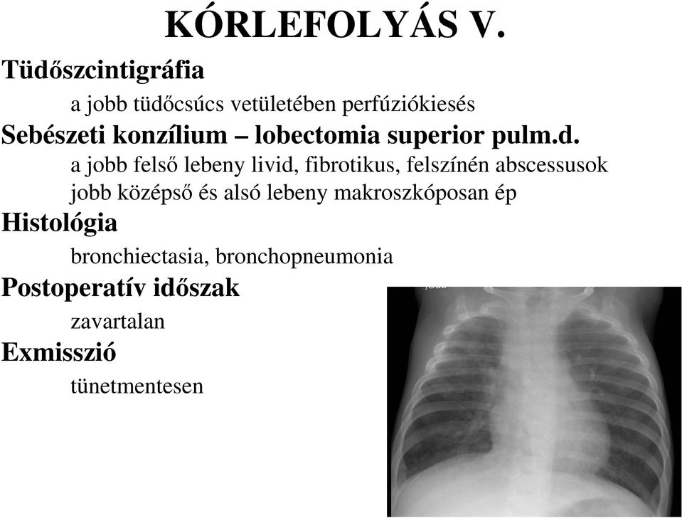 lobectomia superior pulm.d.