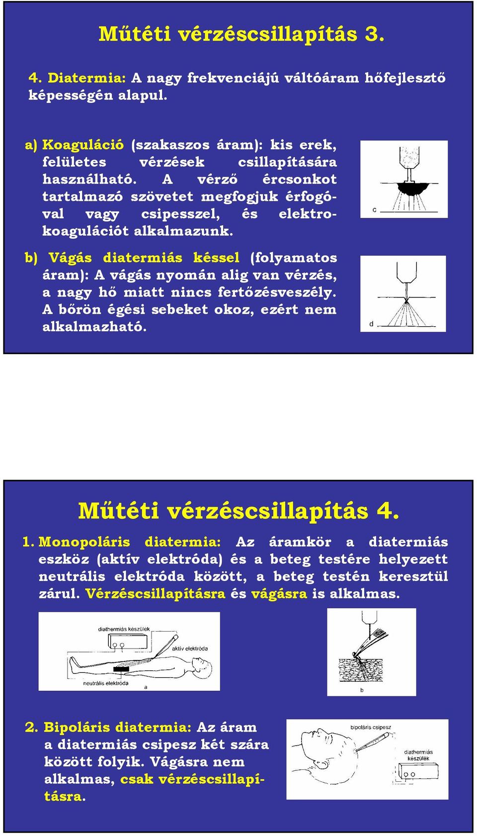 b) Vágás diatermiás késsel (folyamatos áram): A vágás nyomán alig van vérzés, a nagy hő miatt nincs fertőzésveszély. A bőrön égési sebeket okoz, ezért nem alkalmazható. Műtéti vérzéscsillapítás 4. 1.