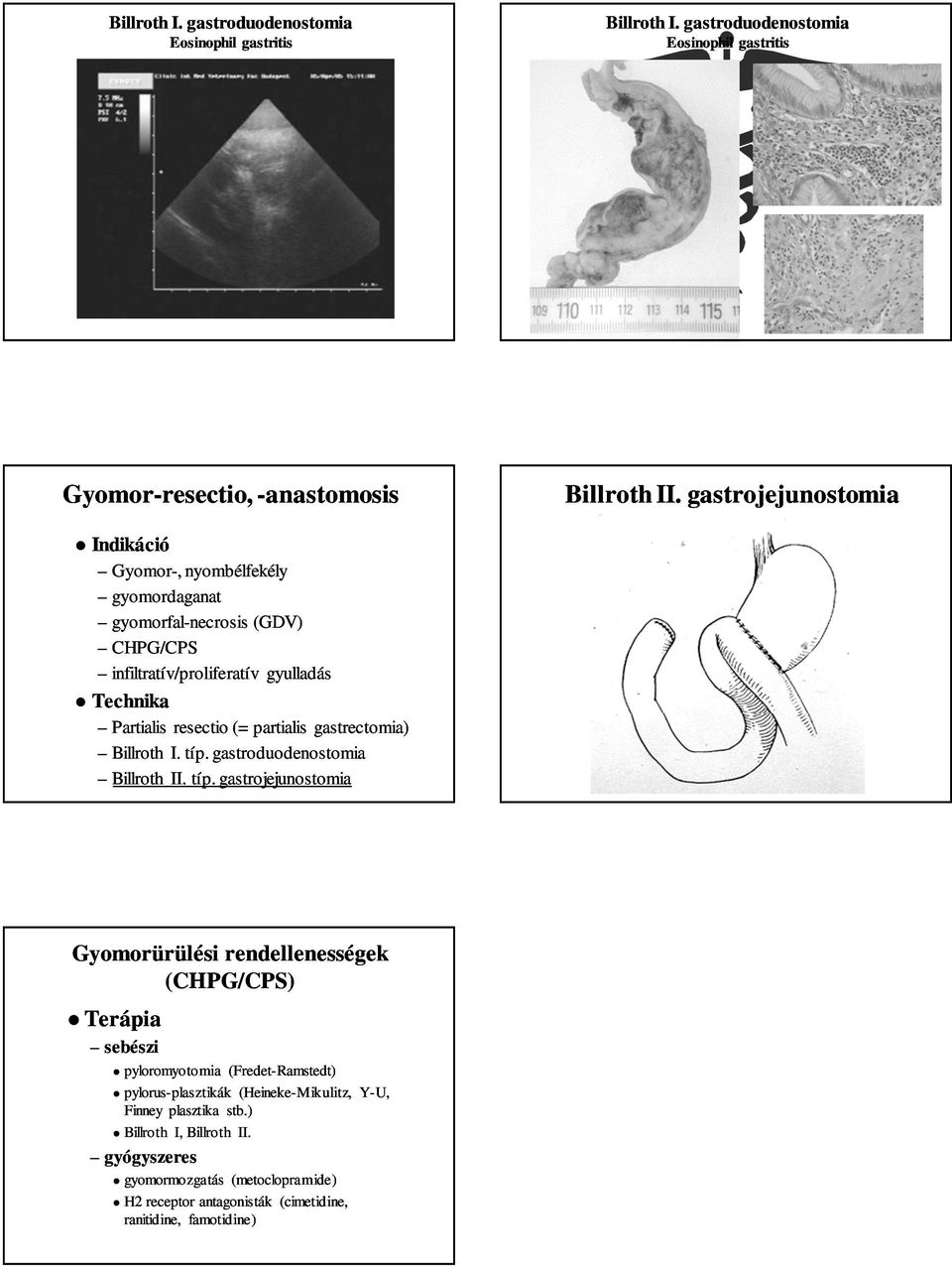 resectio (= partialis gastrectomia) Billroth I. típ.