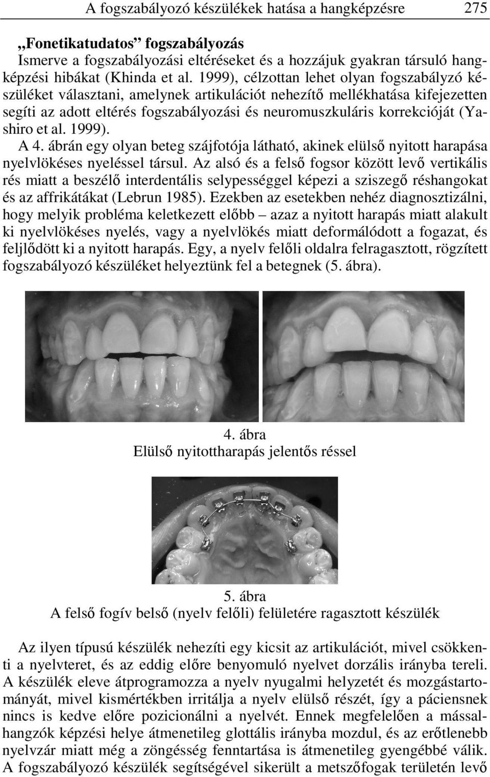 (Yashiro et al. 1999). A 4. ábrán egy olyan beteg szájfotója látható, akinek elülső nyitott harapása nyelvlökéses nyeléssel társul.