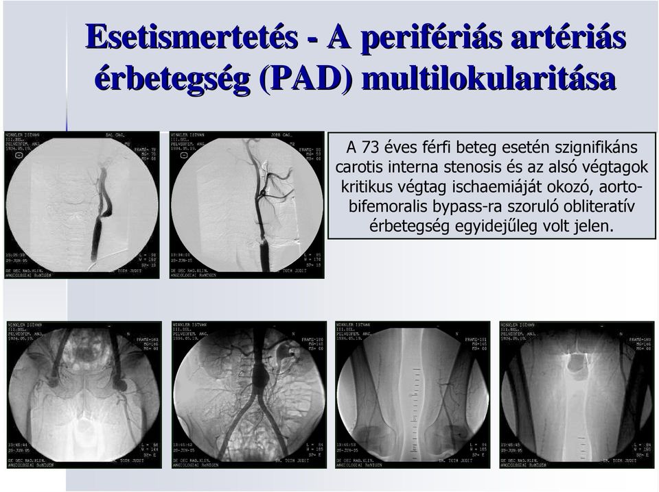 interna stenosis és az alsó végtagok kritikus végtag ischaemiáját