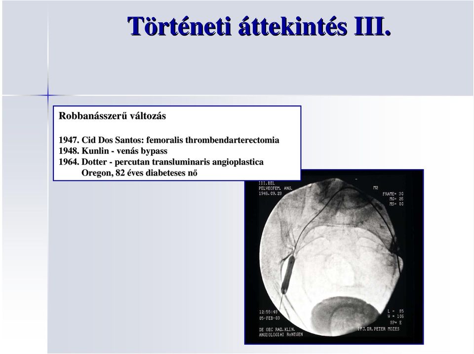 Cid Dos Santos: femoralis thrombendarterectomia 1948.
