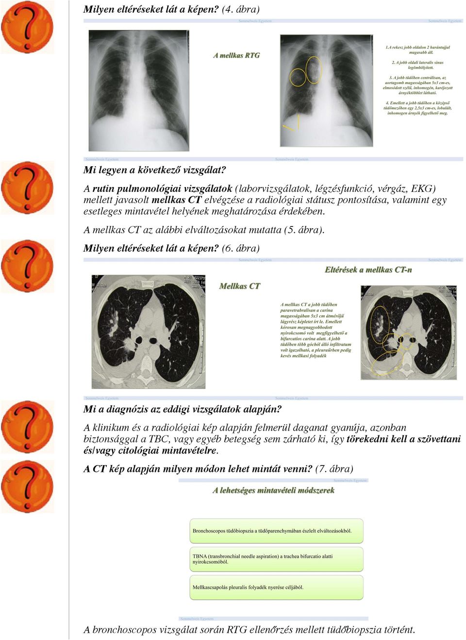 helyének meghatározása érdekében. A mellkas CT az alábbi elváltozásokat mutatta (5. ábra). Milyen eltéréseket lát a képen? (6. ábra) Mi a diagnózis az eddigi vizsgálatok alapján?