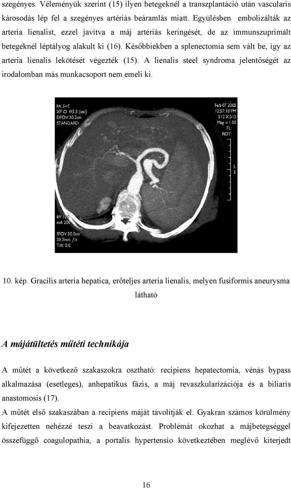 Későbbiekben a splenectomia sem vált be, így az arteria lienalis lekötését végezték (15). A lienalis steel syndroma jelentőségét az irodalomban más munkacsoport nem emeli ki. 10. kép.