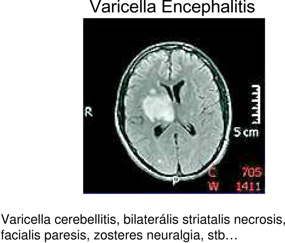 bilaterális striatalis