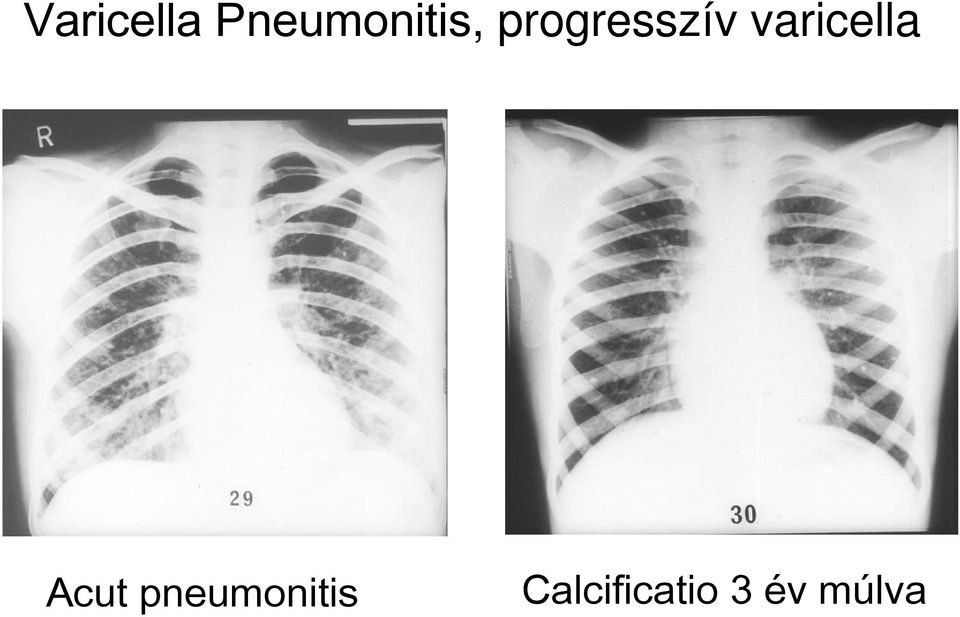 progresszív varicella