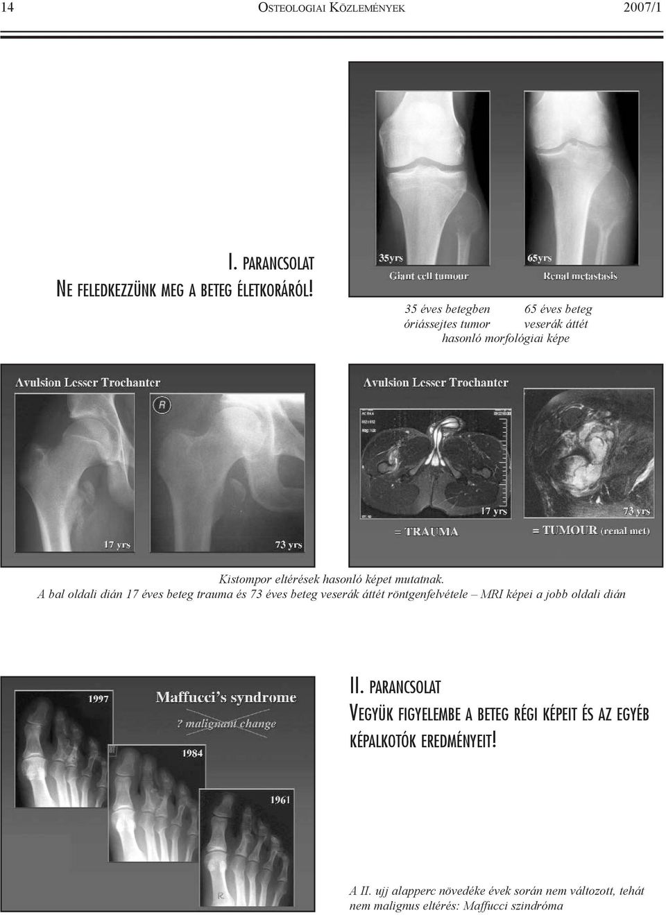 A bal oldali dián 17 éves beteg trauma és 73 éves beteg veserák áttét röntgenfelvétele MRI képei a jobb oldali dián II.