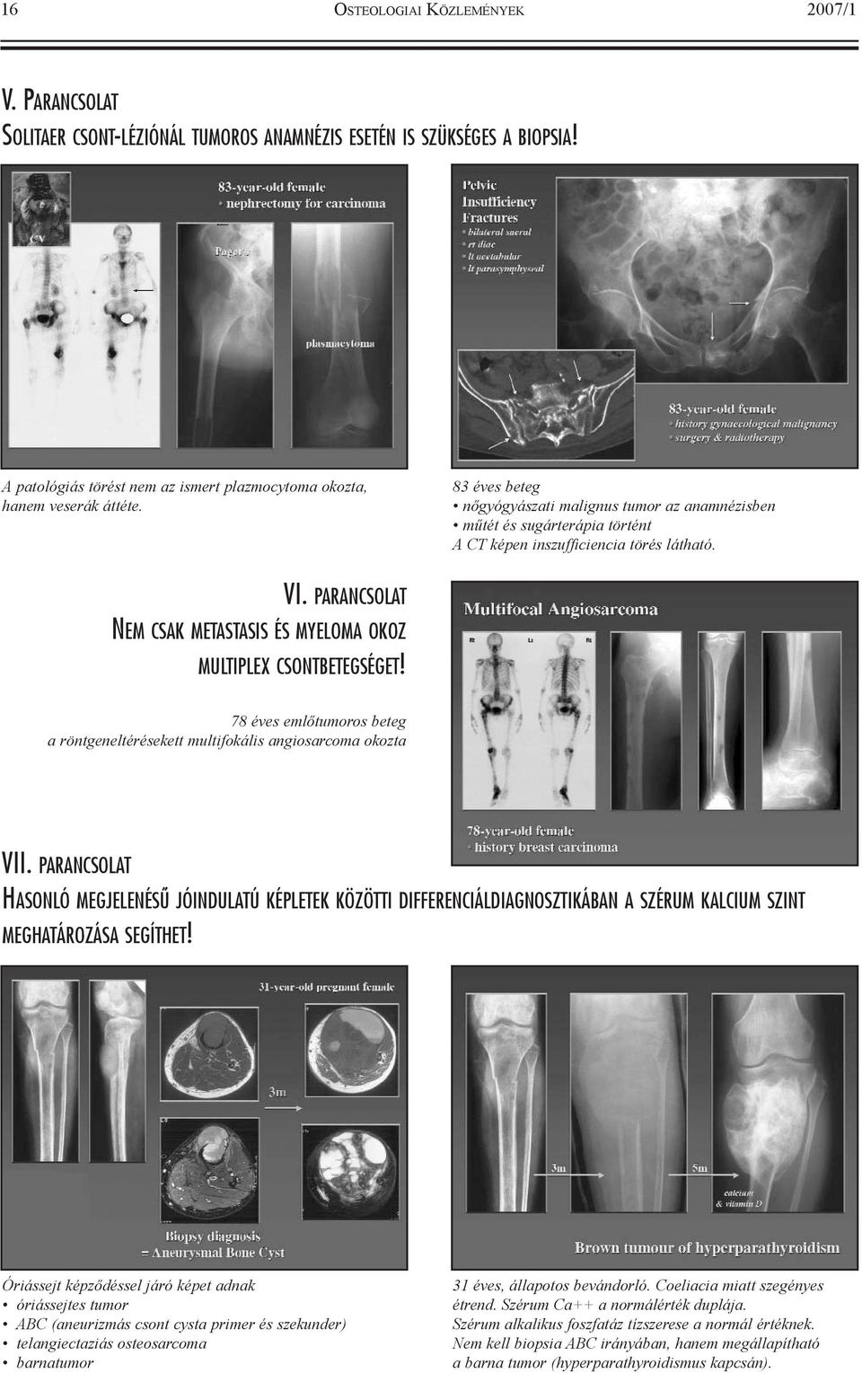 PARANCSOLAT NEM CSAK METASTASIS ÉS MYELOMA OKOZ MULTIPLEX CSONTBETEGSÉGET! 78 éves emlõtumoros beteg a röntgeneltérésekett multifokális angiosarcoma okozta VII.