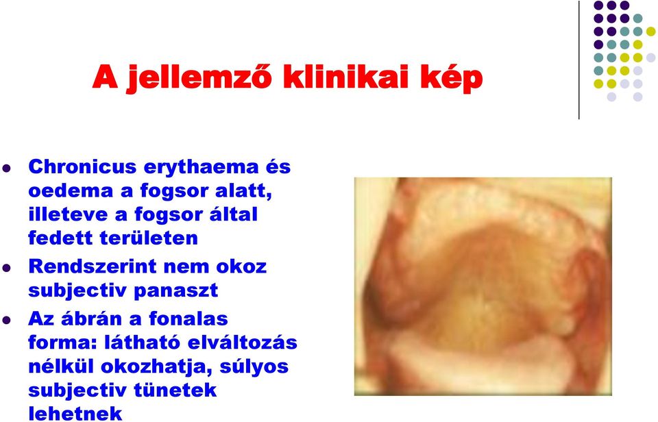 Rendszerint nem okoz subjectiv panaszt Az ábrán a fonalas