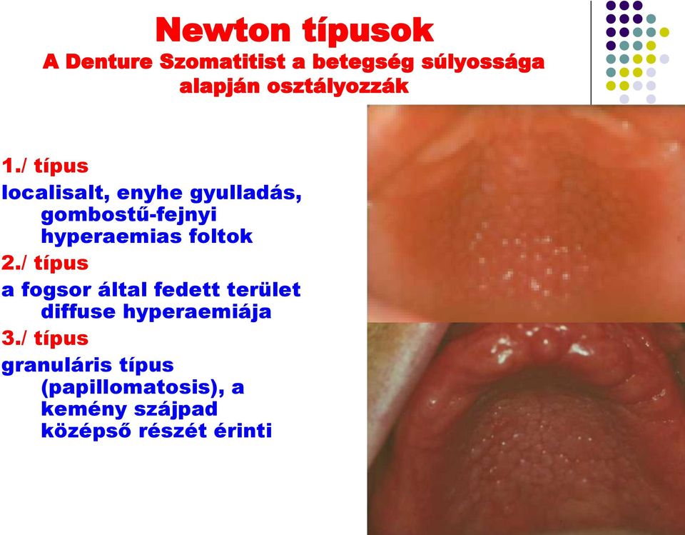 / típus localisalt, enyhe gyulladás, gombostű-fejnyi hyperaemias foltok 2.