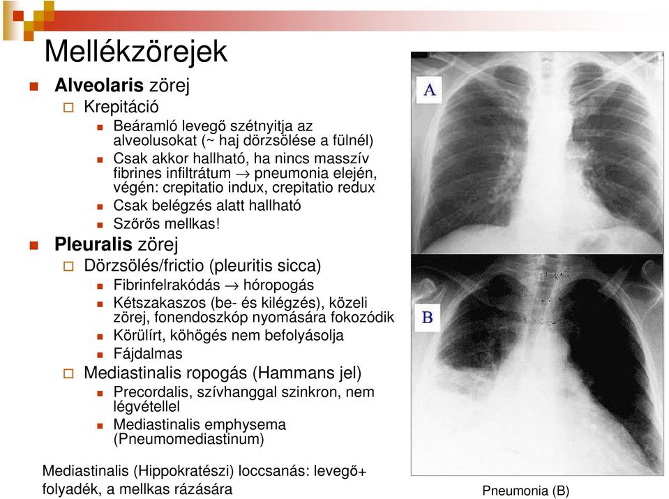 Pleuralis zörej Dörzsölés/frictio (pleuritis sicca) Fibrinfelrakódás hóropogás Kétszakaszos (be- és kilégzés), közeli zörej, fonendoszkóp nyomására fokozódik Körülírt, köhögés