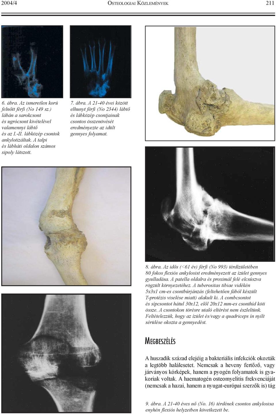 ábra. Az idõs (<61 év) férfi (No 993) térdízületében 80 fokos flexiós ankylosist eredményezett az ízület gennyes gyulladása. A patella oldalra és proximál felé elcsúszva rögzült környezetéhez.