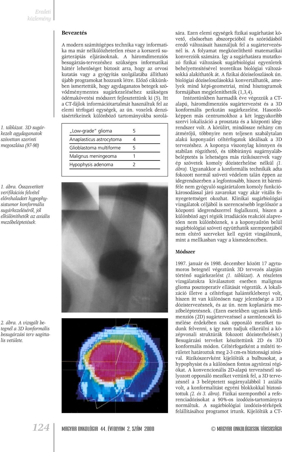 A vizsgált betegnél a 3D konformális besugárzási terv sagittalis vetülete.