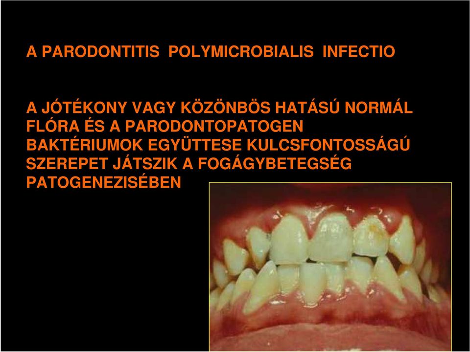 PARODONTOPATOGEN BAKTÉRIUMOK EGYÜTTESE