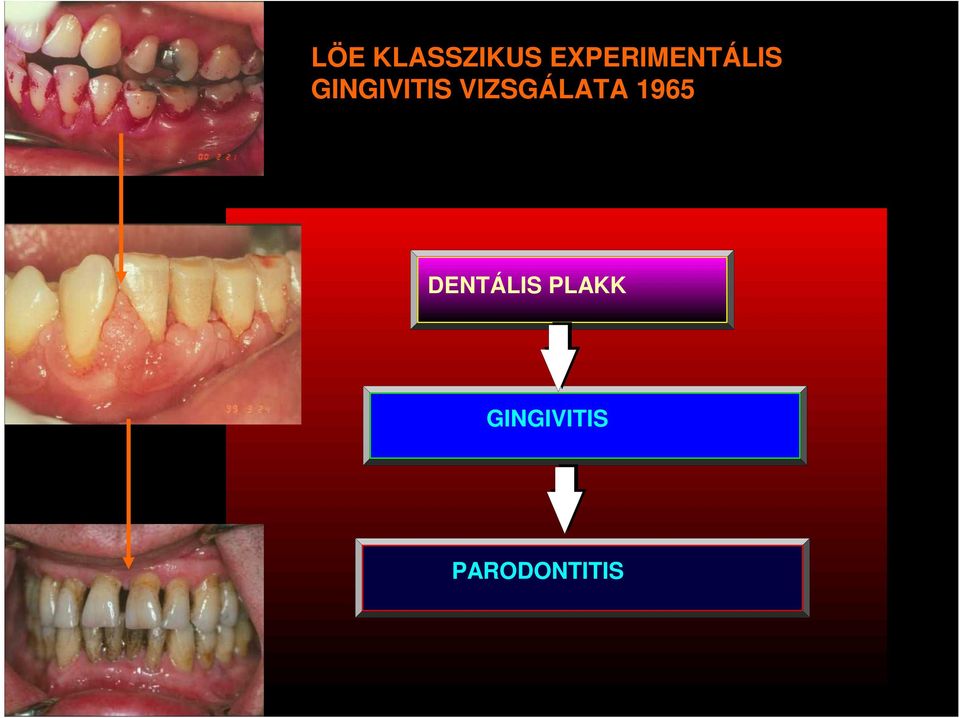 GINGIVITIS VIZSGÁLATA