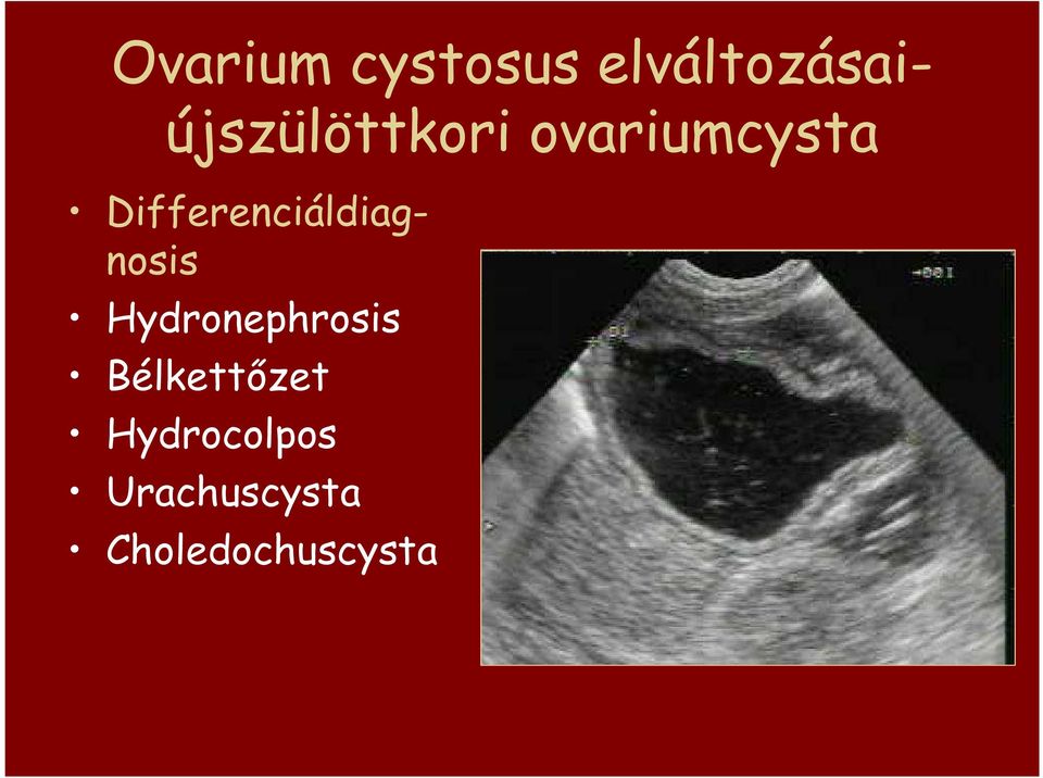 ovariumcysta Differenciáldiagnosis